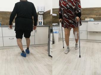 Пациент после протезирования коленного сустава 1 случай
